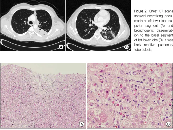 Figure  2.  Chest  CT  scans  showed  necrotizing   pneu-monia at left lower lobe  su-perior  segment  (A)  and  bronchogenic   disseminat-ion  to  the  basal  segment  of left lower lobe (B)