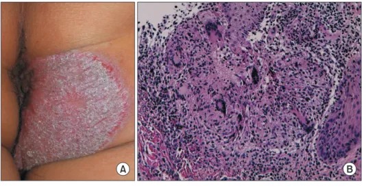 Figure 1. (A) Elevated coalescent ery- ery-thematous scaling plaques on the right  buttock