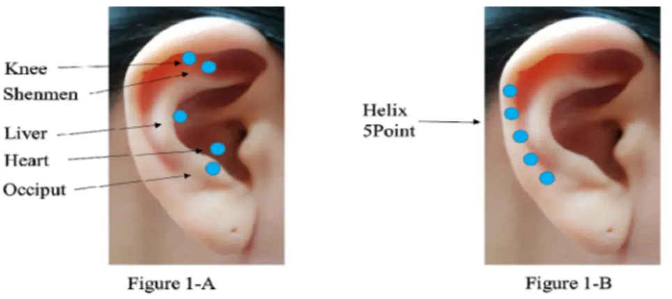 Figure 1. Auricular acupressure point for experimental group (1-A), and placebo control group (1-B)