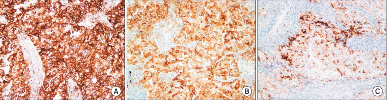 Figure 2. Programmed death-ligand 1 (PD-L1) immunohistochemical (IHC) staining using the PD-L1 IHC 22C3 pharmDx assay (tumor  proportion score [TPS] 80%) (A), the PD-L1 IHC SP263 assay (TPS 90%) (B), and the PD-L1 IHC SP142 assay (TC2, 40%; IC0, 0%) (C) (A