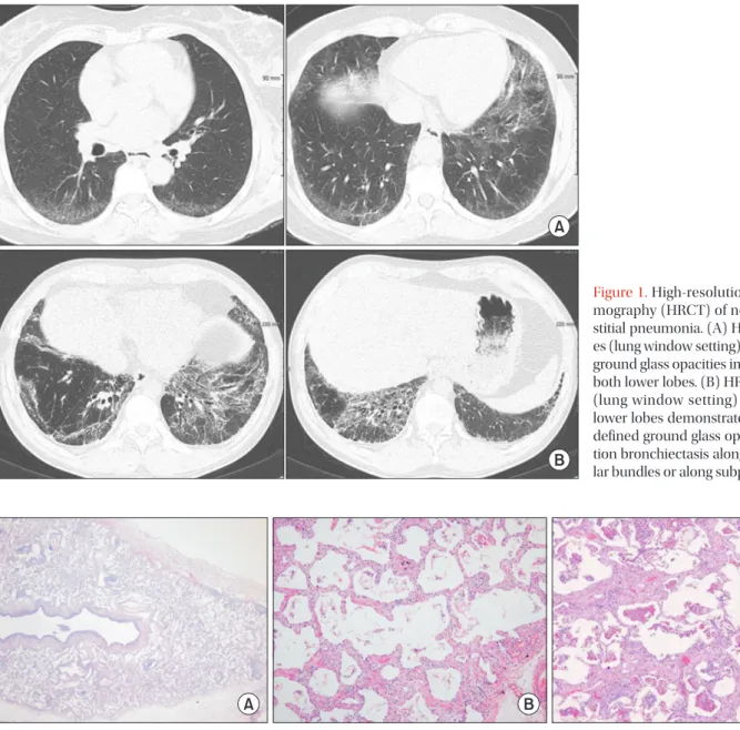 Figure 2. Pathologic findings of nonspecific interstitial pneumonia (NSIP) pattern. (A) Lung architecture is preserved with uniform appear- appear-ance (×20)