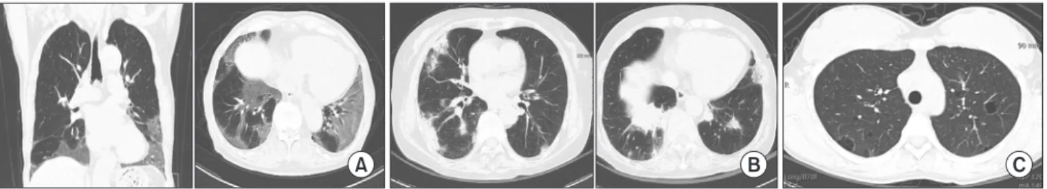 Figure 2. (A) Radiologic pattern of non-specific interstitial pneumonia in a patient with systemic sclerosis