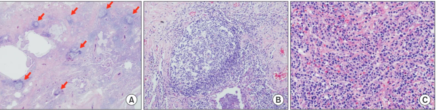 Figure 3. Radiologic pattern of usual interstitial pneumonia in a  patient with rheumatoid-arthritis