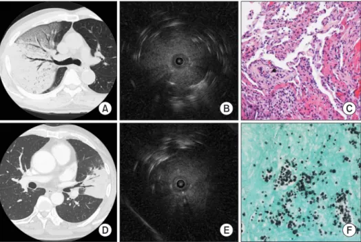 Figure 1. Consolidation. Case 1 was that of a 74-year-old man with dyspnea. (A) Chest computed tomography (CT) showing lobar consolida- consolida-tion with air bronchogram in the right upper lobe
