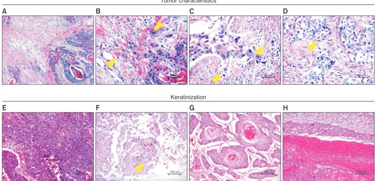 Figure 1. Histologic parameters and patterns of keratinization applied in this study. Tumor budding is observed along tumor edge (A); this is  defined as the presence of structures comprising fewer than five tumor cells (arrowheads) at higher magnification