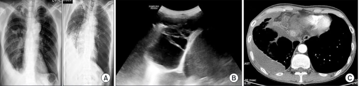 Figure 1. The representative radiographic finding of loculated tuberculous pleural effusion