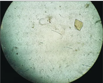 Figure 3. Wet-mount of stool showing larvae of Strongyloides ster- ster-coralis (×400).