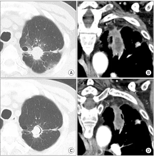 Figure 1. Enhanced chest computed to- to-mography (CT) findings. (A, B) Chest CT  on admission day shows about 4.1-cm  irregular shaped mass with spiculated  margin at left upper lobe