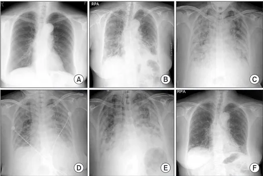 Figure 1. Chest X-ray film at 2 months  prior to admission (A), on admission  (B), before the first intubation (C), after  the first extubation (D), after the second  intubation (E), and at discharge (F)