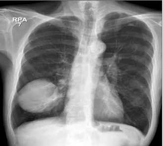 Figure 1. Chest X-rays shows a well-defined round homogenous  opacity in the right lower lung field