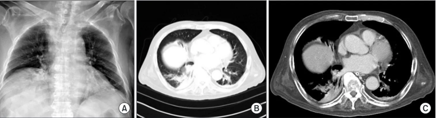 Figure 2. Chest radiograph and chest computed tomography findings after treatment. (A) Chest radiograph taken 2 months after commence- commence-ment of antibiotic treatcommence-ment showing resolution of the cystic lesion in the right lower lung zone