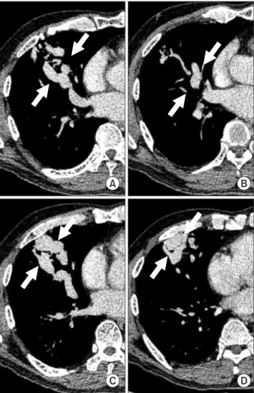 Figure 1. Initial chest radiograph showing a mass-like opacity in the  right lower lung field.