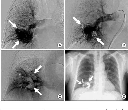 Figure 3. Angiography visualizing a large  pulmonary arteriovenous malformation  with multiple complex feeding arteries  (A)