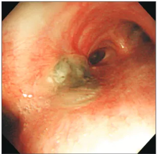 Figure 2. (A) An axial chest computed tomography (CT) image at the level of the left atrium shows lobar consolidation of the right lower  lobe