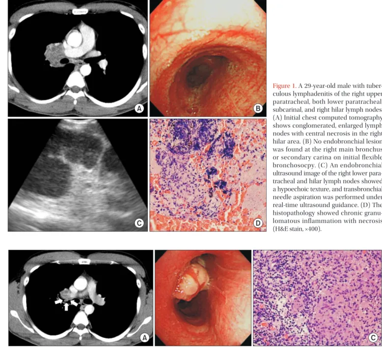 Figure 2. Computed tomography was performed to assess the treatment response after 6 months of antituberculosis treatment