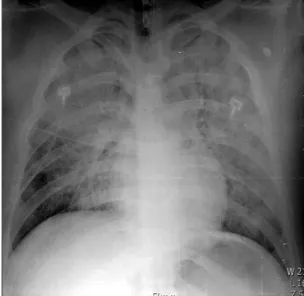 Figure 2. Initial chest computed tomog- tomog-raphy (CT) scan showing bilateral diffuse  airspace opacity consistent with acute  respiratory distress syndrome