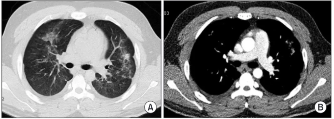 Figure 3. Chest computed tomography  (CT) on 10th day showing much clearing  of the bilateral alveolar opacity
