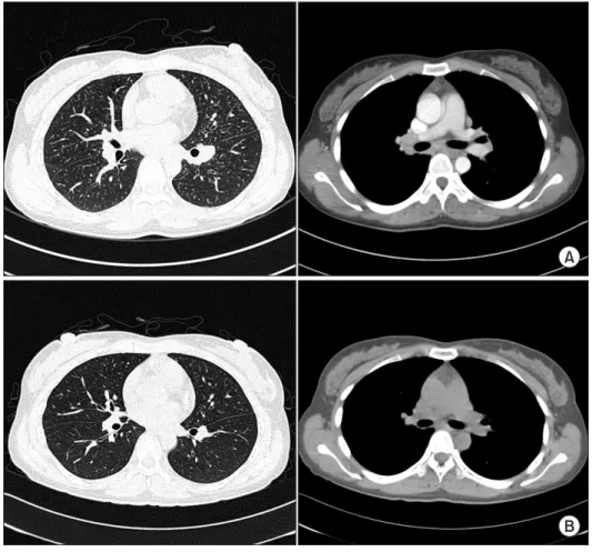 Figure 1. Chest computed tomography  (CT) on admission (A) and at 3 months  after suitable precaution (B)