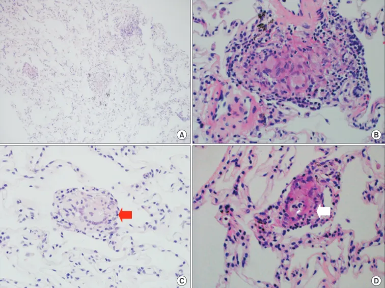 Figure 2. Histologically, the lung biopsy reveals multifocal small and discrete non-caseating epithelioid granulomas containing foreign body- body-type giant cells