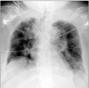 Figure 2. The initial bronchoscopy shows  excessive dynamic airway compression  at exhalation (A) and inhalation (B)