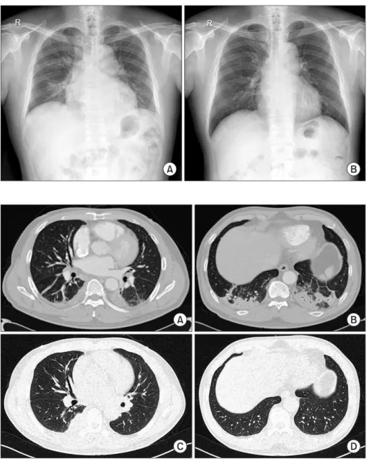 Figure 1. Chest radiography images of  the patient. (A) Initial chest radiography  showing multiple pulmonary  consolida-tions