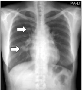 Figure 1. Chest X-ray showing multiple lung nodules with multifo- multifo-cal haziness in the right lung.