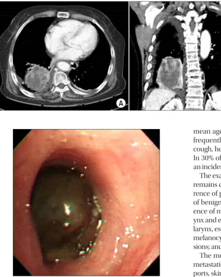 Figure 1. (A, B) Chest computed tomog- tomog-raphy showing a heterogeneous  enhanc-ing mass of 8 cm containenhanc-ing an inner low  attenuating portion in the right lower  lobe.