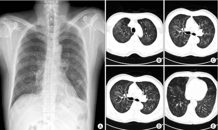 Figure 1. (A–E) Chest radiography showed subtle diffuse ground glass opacity in both lower lobe field and subsegmental atelectasis in left  lower lobe field on admission