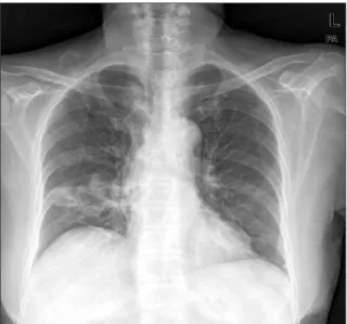 Figure 2. (A) Coronal image of the chest obtained using computed tomography (CT) scan revealed multiple variable-sized mediastinal lymph  nodes