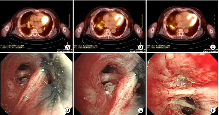 Figure 2. Positron emission tomography computed tomography showed multiple high uptake lesions (A–C), and bronchoscopic biopsy was  obtained from anterobasal segment of right lower lobe (D–F).