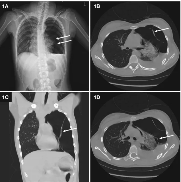 Figure 1. A chest X-ray (A) reveals a spontaneous pneumothorax with right-sided tracheal deviation and a centered consolidation of the left lung,  which means entirely collapsed lung