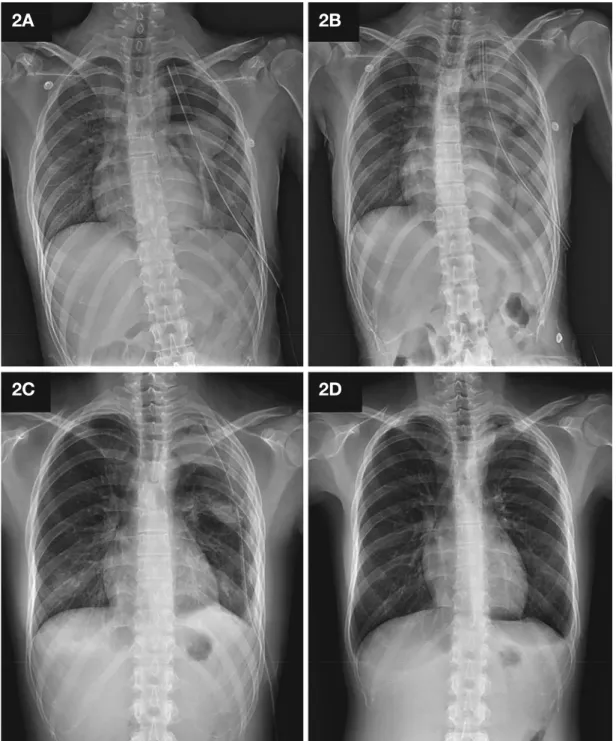 Figure 2. The left lung was expanded after the closed thoracostomy (A), and a re-expansion pulmonary edema occurred unfortunately (B)