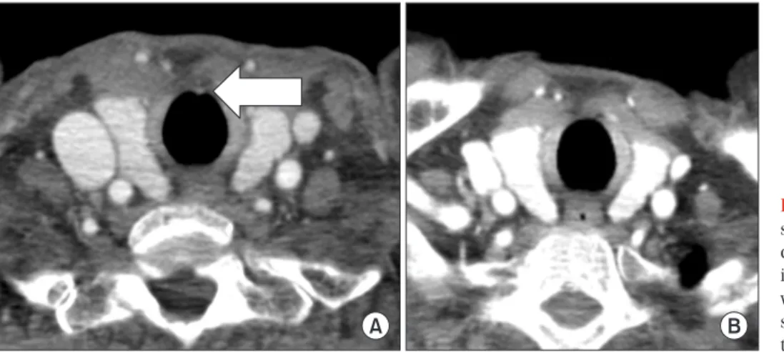 Figure 2. Chest computed tomography  scans. (A) Initial imaging showed a  fo-cal enhancement smaller than 5 mm  in the midline of the anterior tracheal  wall (arrow)