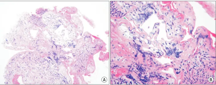 Figure 3. Photograph of histopathological specimen showing multiple dilated vascular spaces containing a few red blood cells (A, H&amp;E stain, 