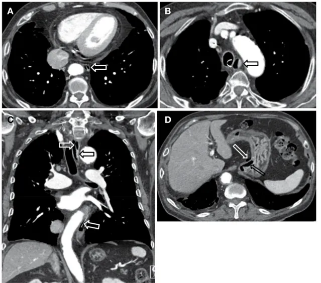 Figure 1. Chest CT images of a 74-year-old woman with abrupt chest pain during upper GI endoscopy