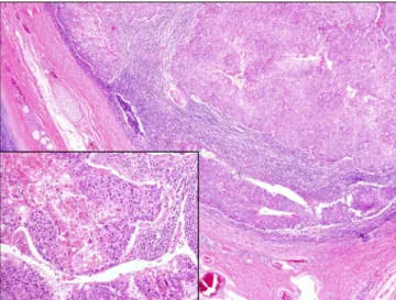 Figure 2. Grossly, several enlarged lymph nodes (arrows) were  found in the hilar and interlobar area.