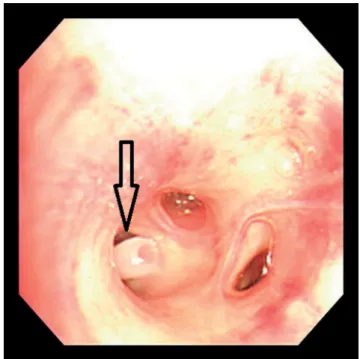 Figure 2. Postoperative chest computed tomography shows focal tubu- tubu-lar lesion within the the posterobasal segmental bronchus in the right  lower lobe