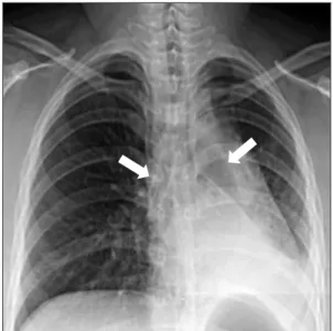 Figure 1. Initial chest radiography shows atelectasis of left lower  lung field and metallic stents are placed at both main bronchus  (ar-rows).