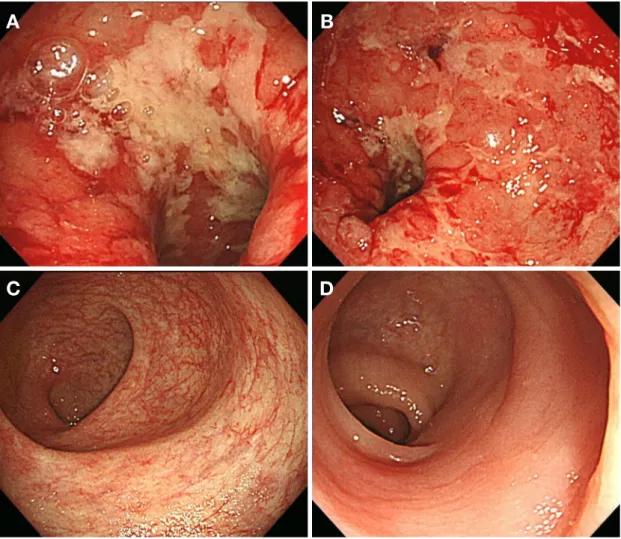 Figure 1. Colonoscopic findings of the patient with ulcerative colitis. (A, B) Colonoscopy showed severe, active ulcerations with hemorrhagic  mucosa in the rectosigmoid area