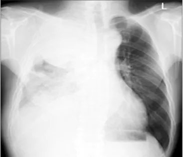 Figure 1. The initial chest radiograph at our hospital shows a huge  mass with multiple pleural nodules and pleural effusion in the right  hemithorax.