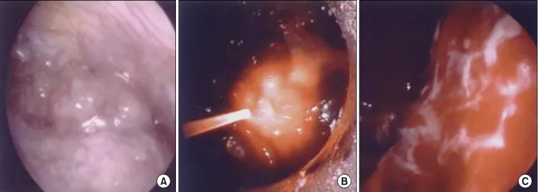 Figure 3. (A) The pleural mass. (B) Photodynamic therapy taking place. Laser light is being delivered into the pleural cavity via the optical fi- fi-ber