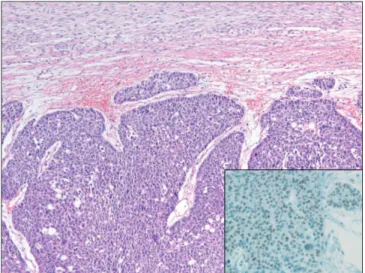Figure 3. The ovary showing thick trabeculae or nests of solid vari- vari-ant adenocarcinoma (H&amp;E stain, ×100)