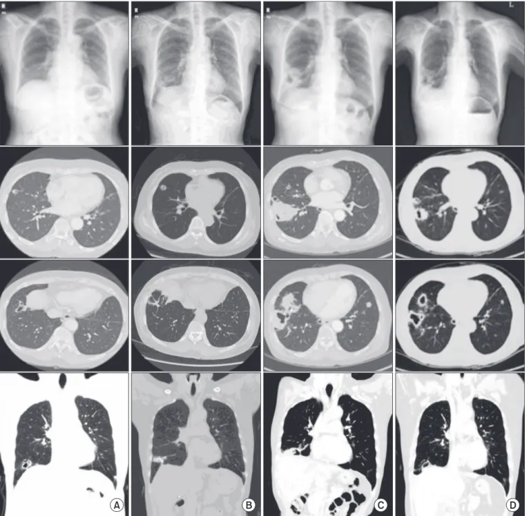 Figure 1. Radiologic findings. (A) Multifocal area of small nodules with cavitation in the right lower lung fields at 21 months prior to admis- admis-sion