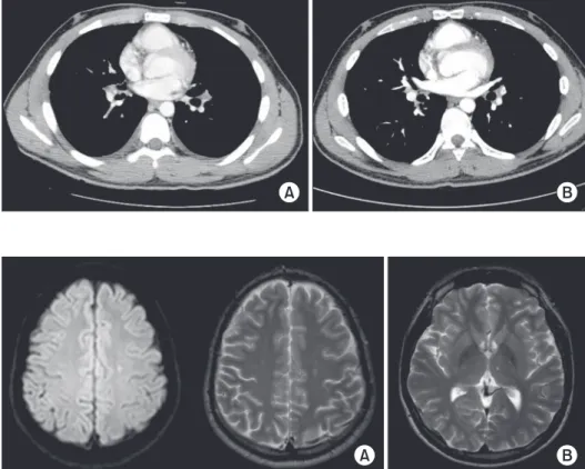 Figure 4. Brain magnetic resonance im- im-age. Hyper-intense foci are seen in the  left centrum semiovale on T2-weighted  image (A) and diffusion-weighted images  (B)