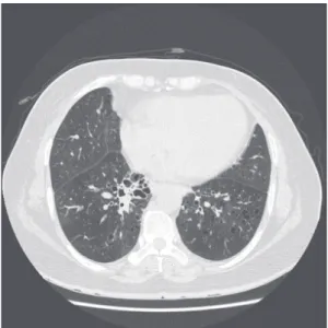 Figure 1. High-resolution computed tomography of an asthma pa- pa-tient with bronchiectasis.