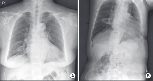 Figure 1. (A) Follow-up chest posterior- posterior-anterior plain radiograph taken at 14 days  after admission shows  pneumoperitone-um