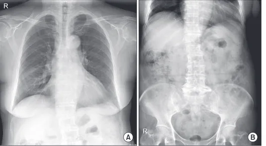 Figure 3. (A) Follow-up chest posterior- posterior-anterior plain radiograph taken at 9 days  after  pneumoperitoneum  was  noted  shows regression of pneumoperitoneum