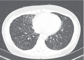 Figure 2. A chest computed tomography scan performed 2 years  later in the studied patient showing an increased extent of the  nod-ules, particularly in the right middle lobe and right lower lobe, and  newly developed patchy consolidation in the right lowe