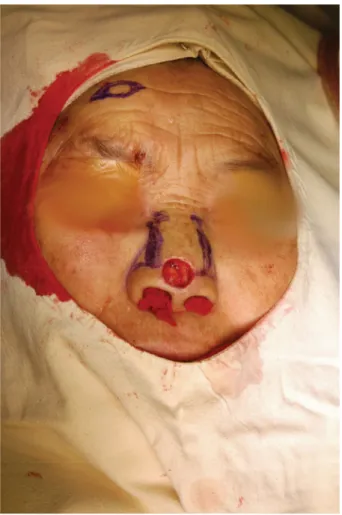 Figure 2.  Intraopertive views: Advancement flap design with applied  nasal aesthetic unit.