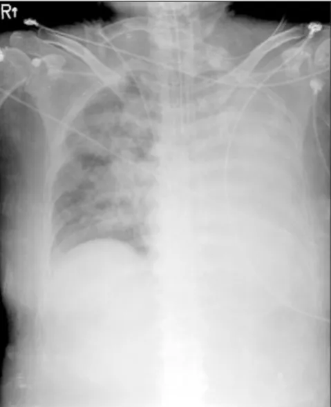Figure 2. Left main bronchus obstructed by blood clots.